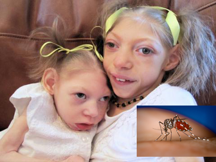 Muỗi là nguyên nhân chính lây truyền Virus Zika "ăn não người" ở trẻ em
